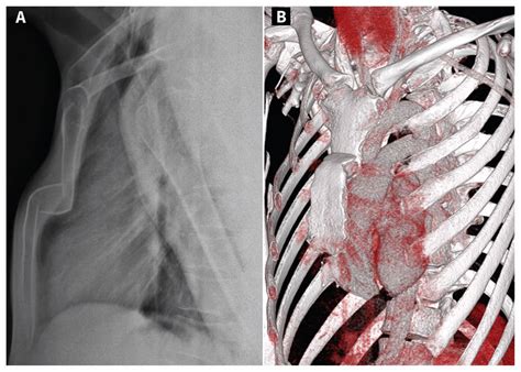 sternum fracture surgery